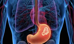 Ung thư dạ dày 'ẩn' dưới triệu chứng rối loạn tiêu hóa